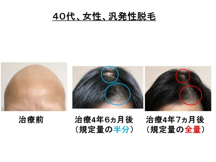 円形脱毛症　病院